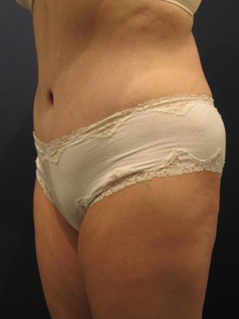 Mommy Makeover Before & After