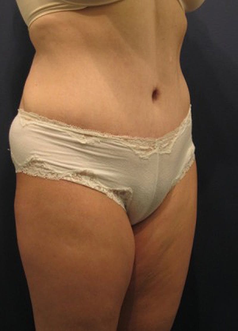 Mommy Makeover Before & After