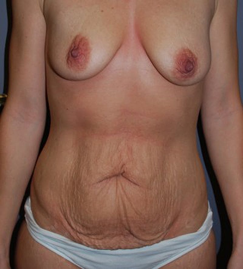 Mommy Makeover Before & After