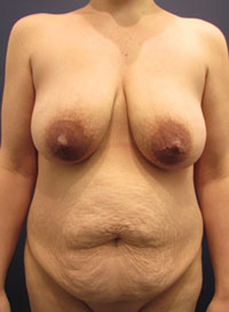 Mommy Makeover Before & After