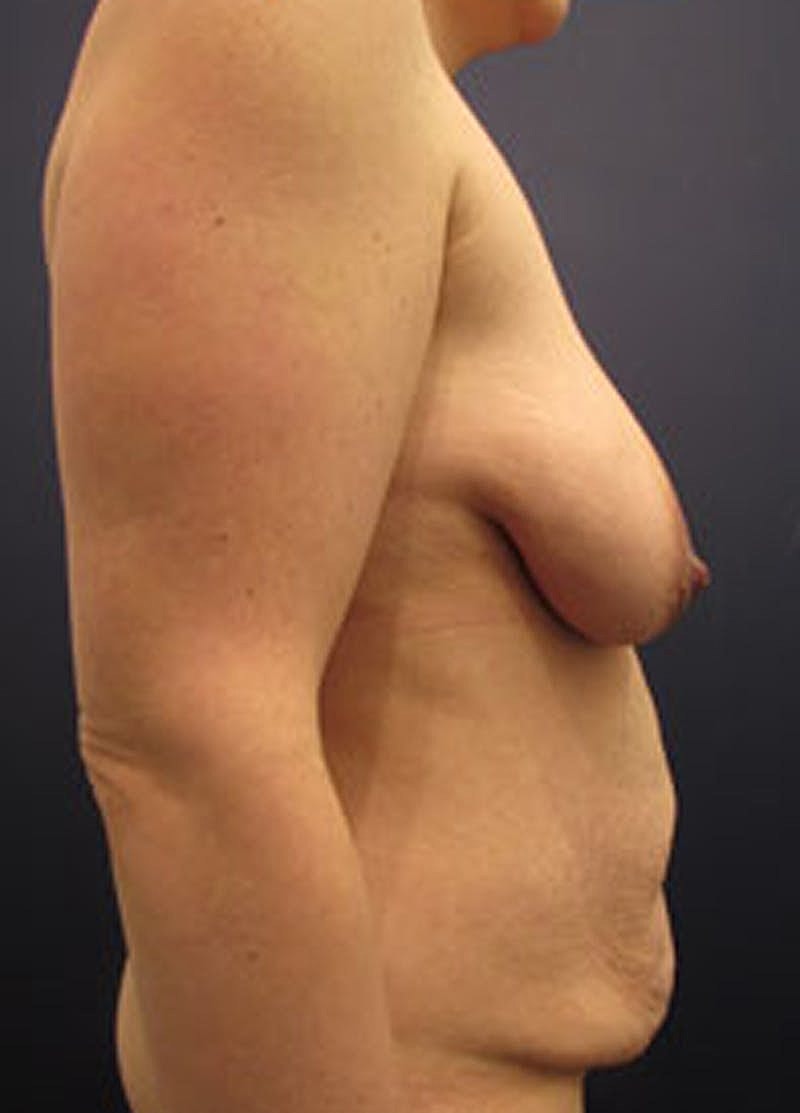 Mommy Makeover Before & After