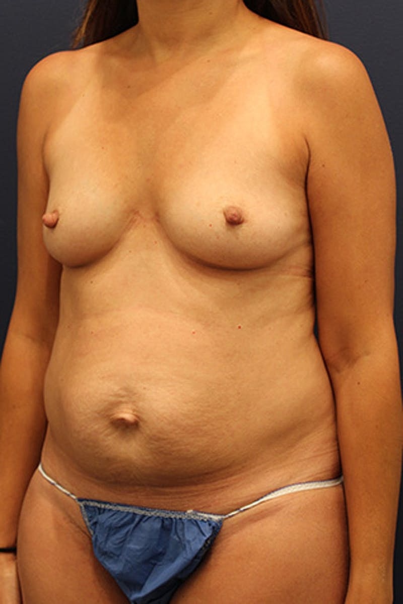 Mommy Makeover Before & After