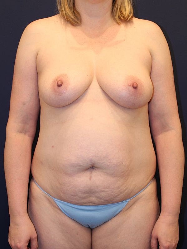 Breast Fat Transfer Before & After