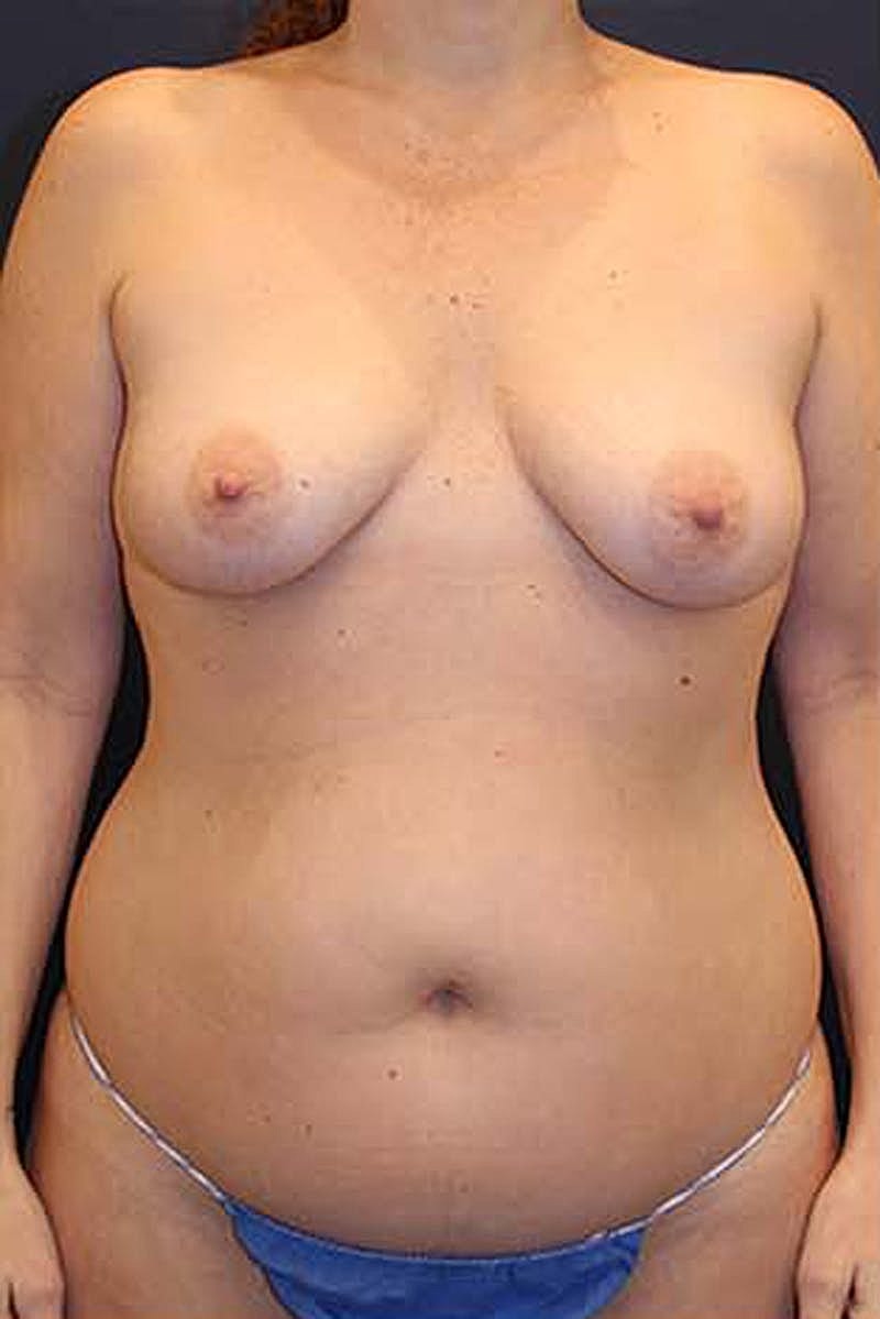 Breast Fat Transfer Before & After