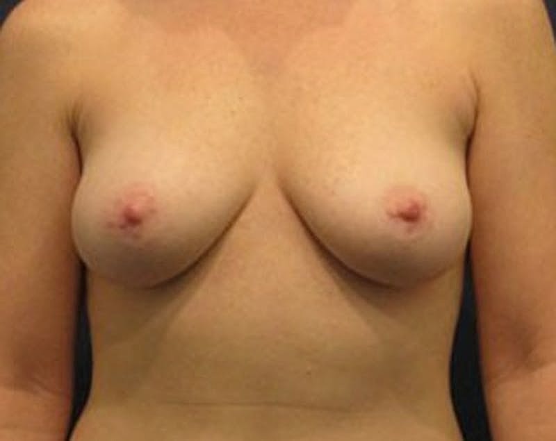 Breast Fat Transfer Before & After