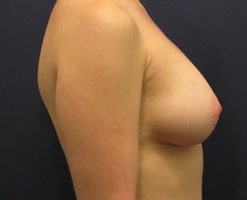 Breast Fat Transfer Before & After