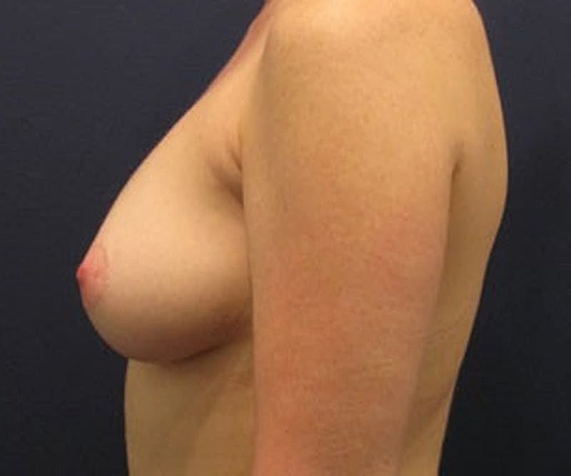 Breast Fat Transfer Before & After