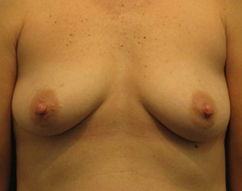 Breast Fat Transfer Before & After