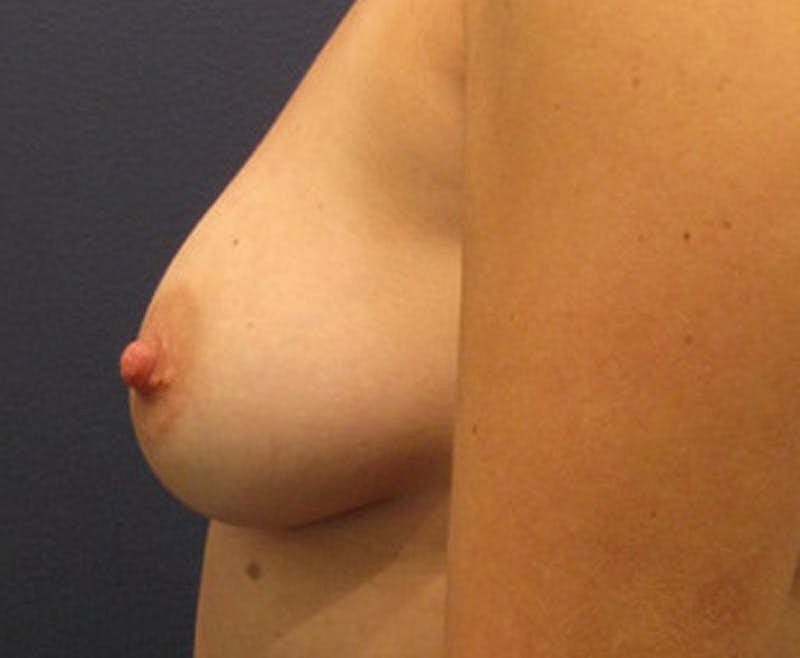 Breast Fat Transfer Before & After