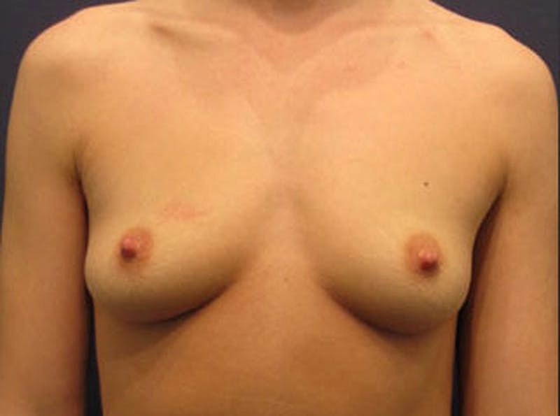 Breast Fat Transfer Before & After