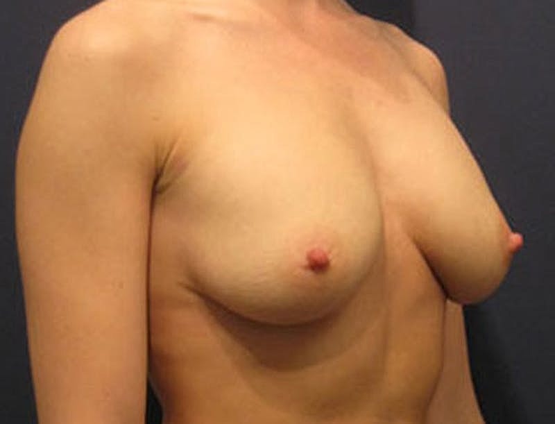 Breast Fat Transfer Before & After