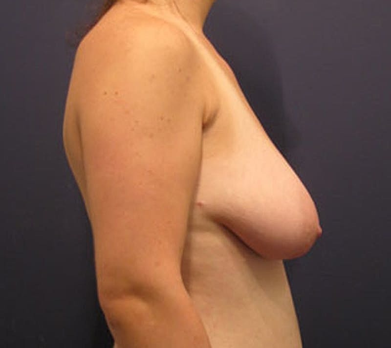 Breast Fat Transfer Before & After
