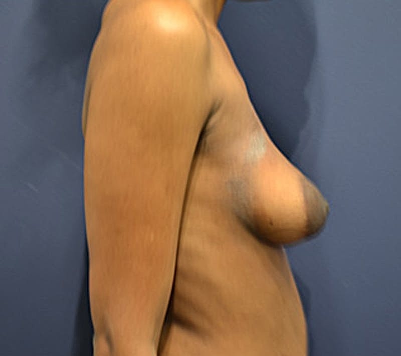 Breast Fat Transfer Before & After