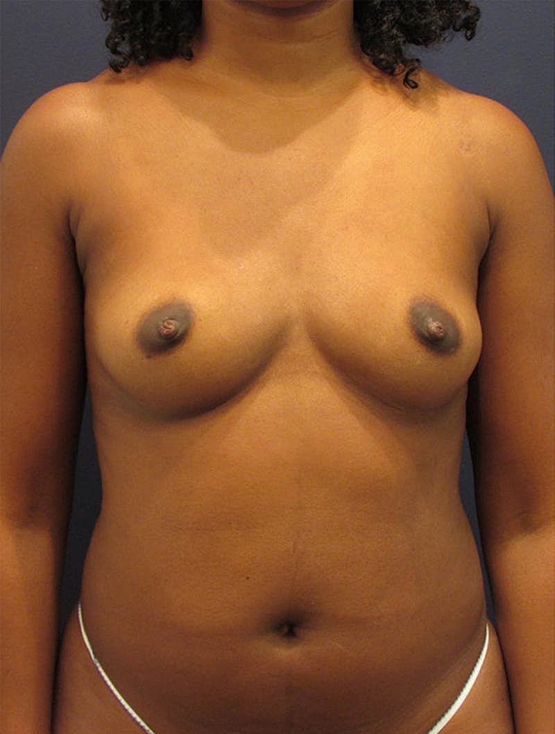 Breast Fat Transfer Before & After