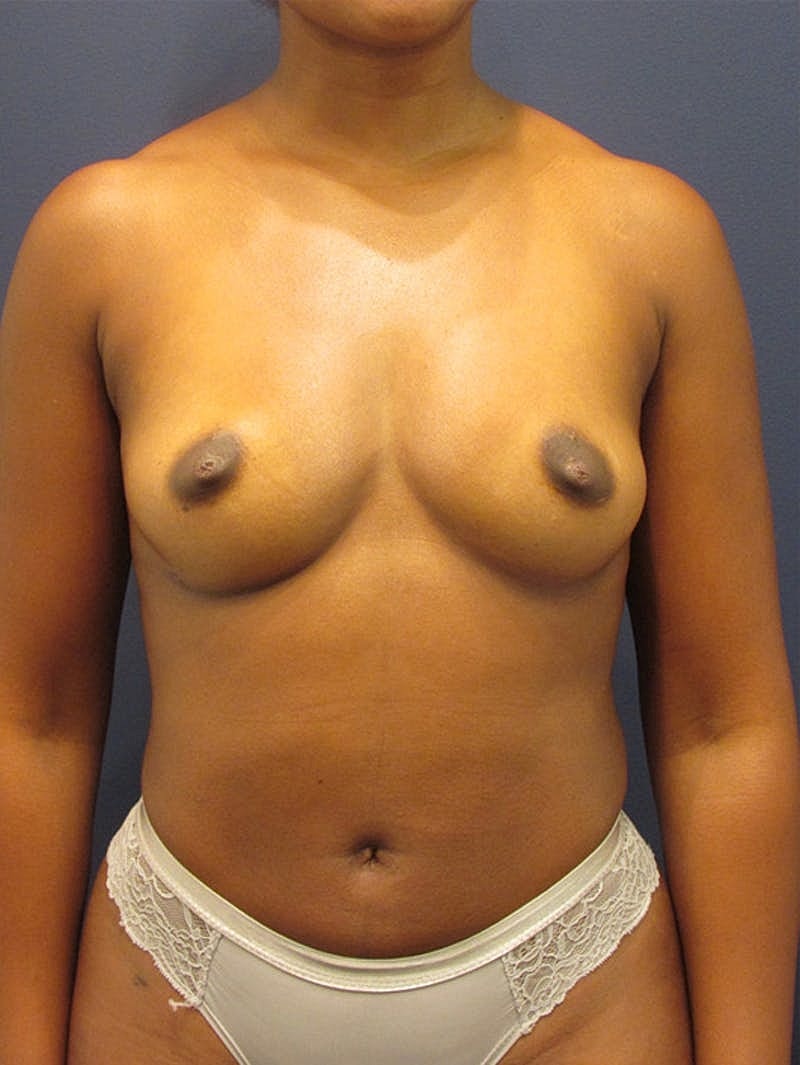 Breast Fat Transfer Before & After