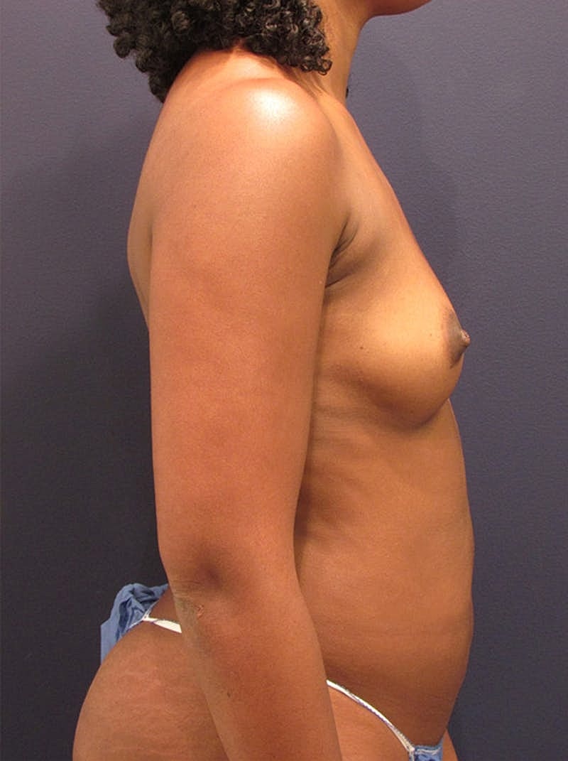 Breast Fat Transfer Before & After