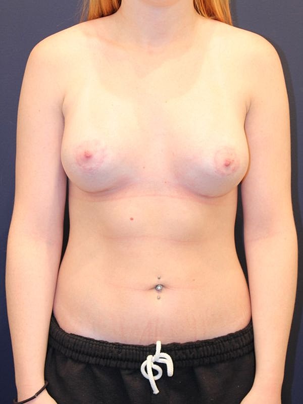 Breast Asymmetry Gallery Before & After
