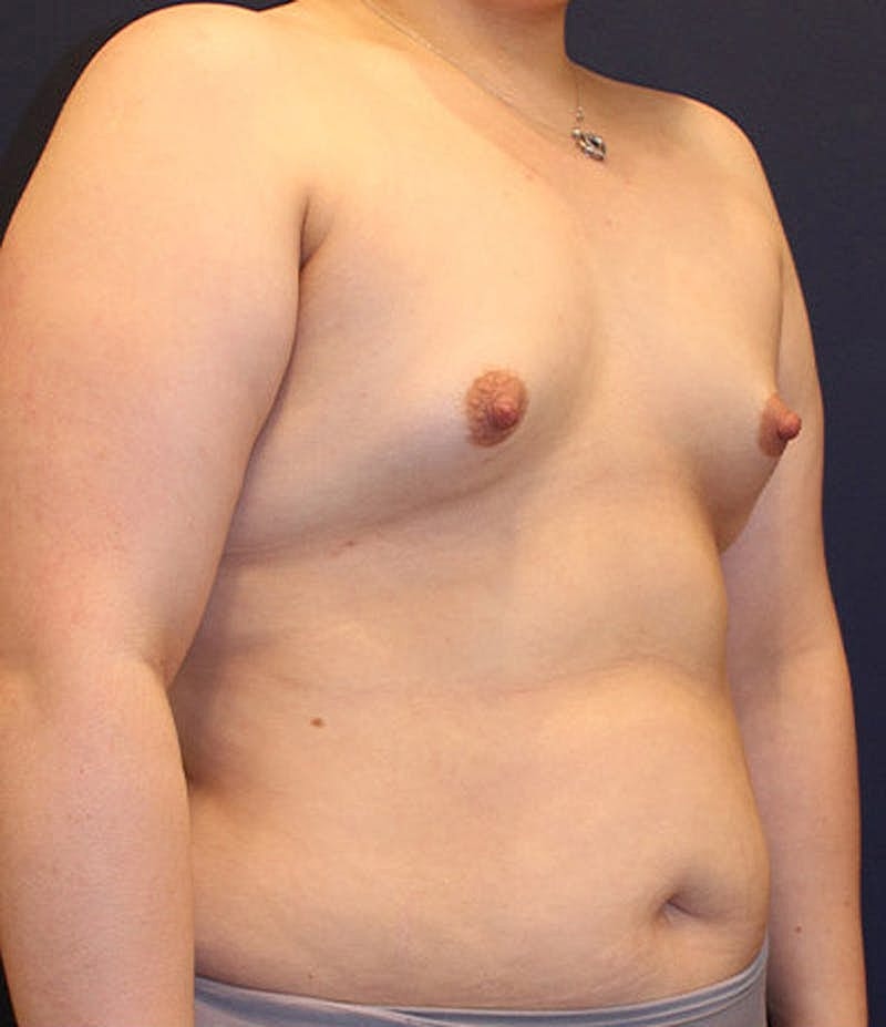 Breast Asymmetry Before & After