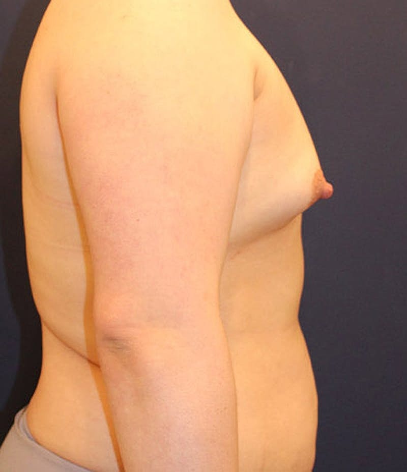 Breast Asymmetry Before & After