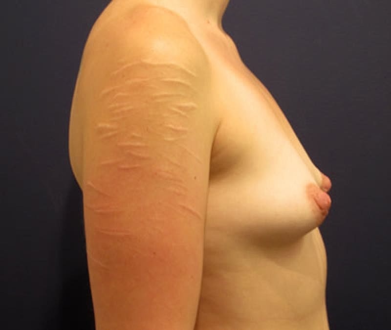 Breast Asymmetry Before & After