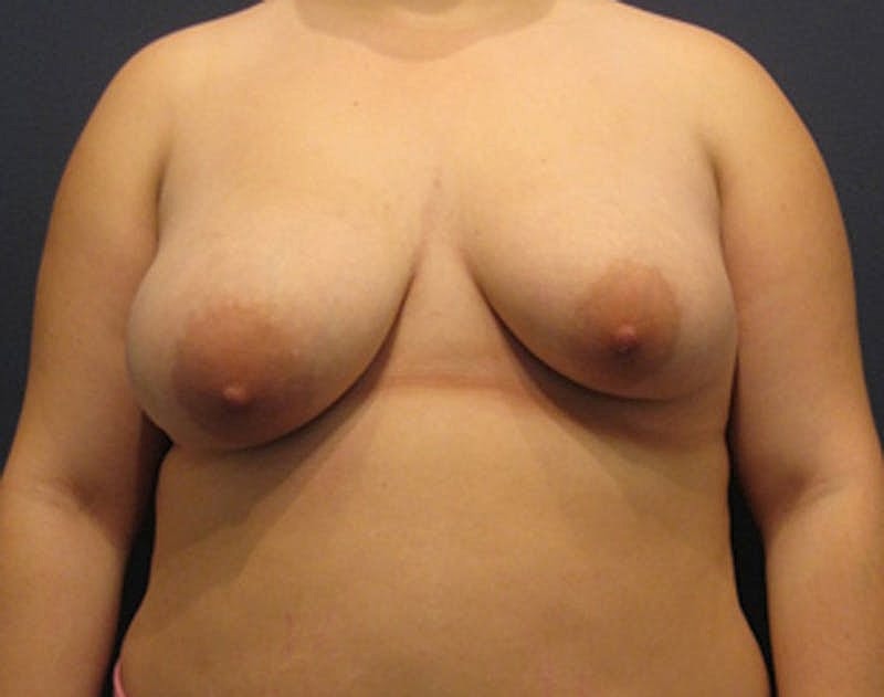 Breast Asymmetry Before & After