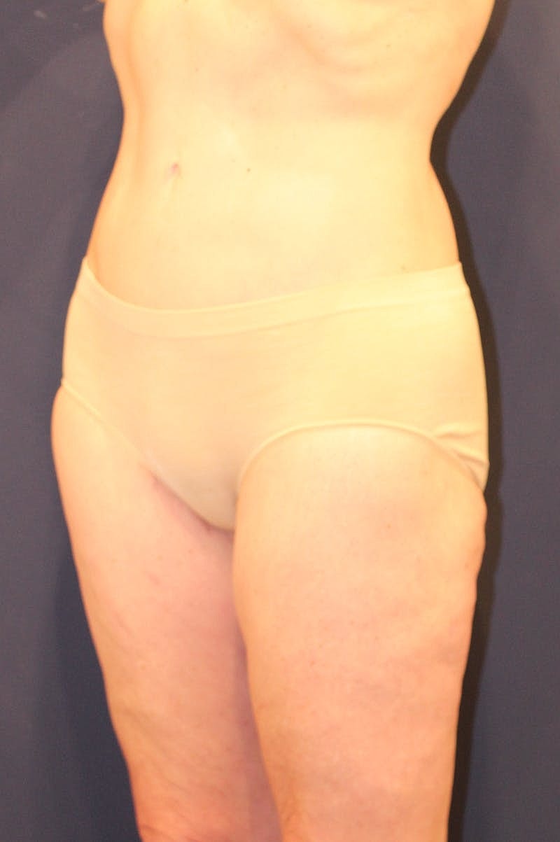 Thigh Lift Before & After