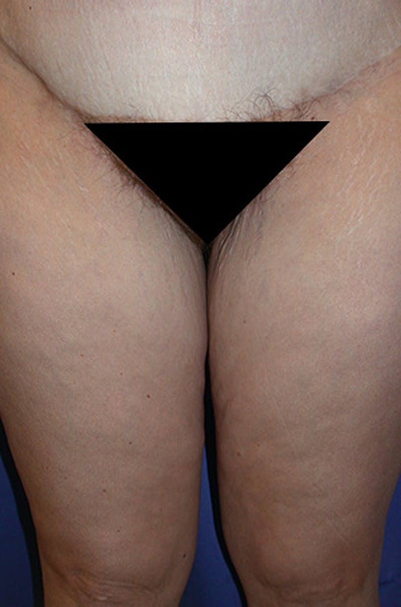 Thigh Lift Before & After