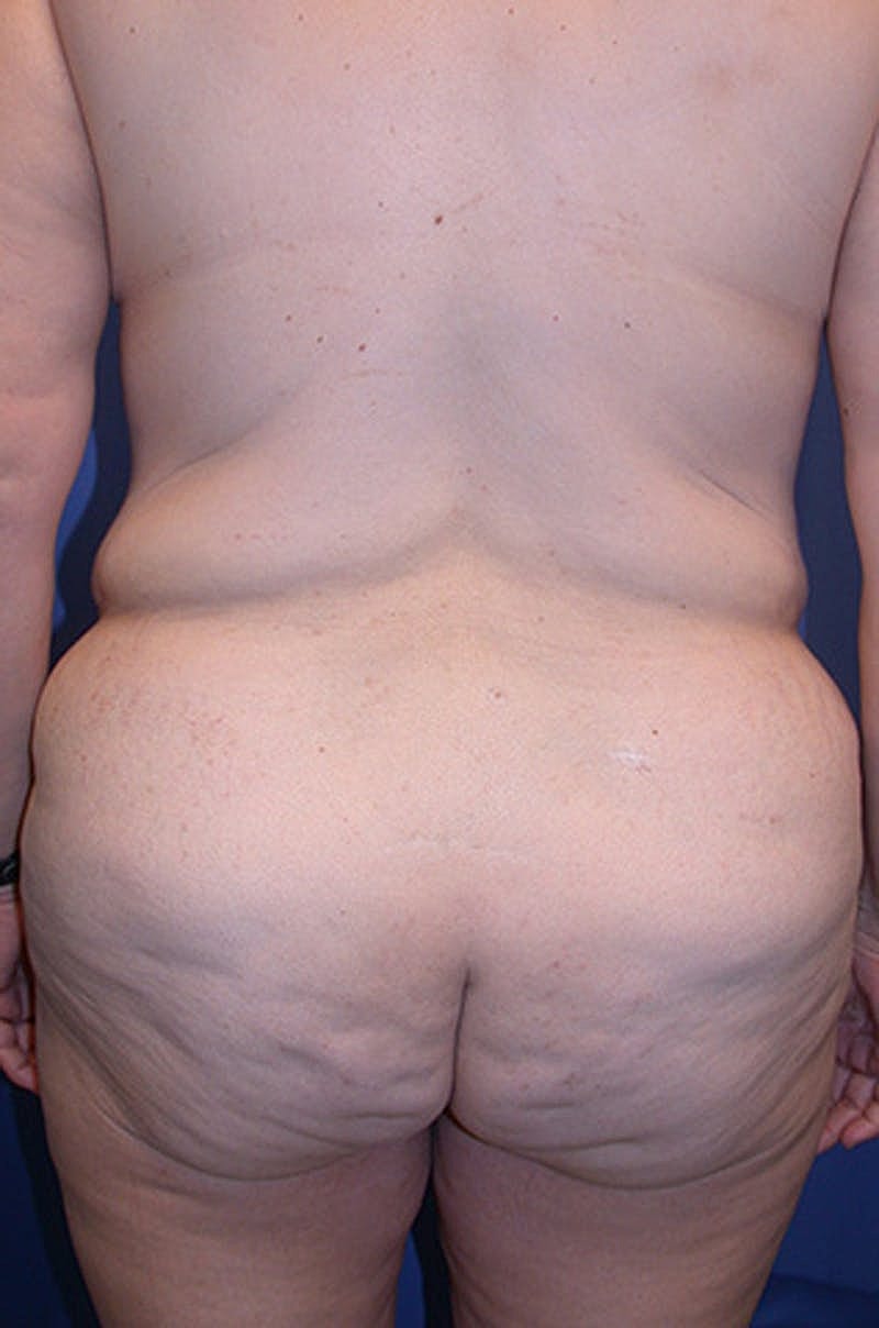 Thigh Lift Before & After