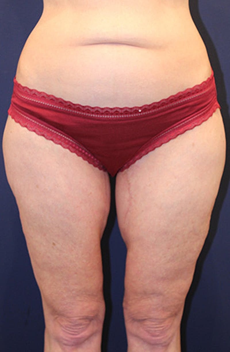 Thigh Lift Before & After