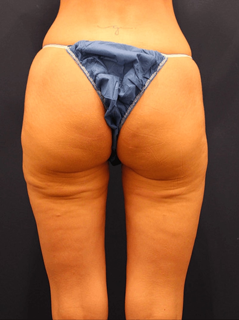 Thigh Lift Before & After