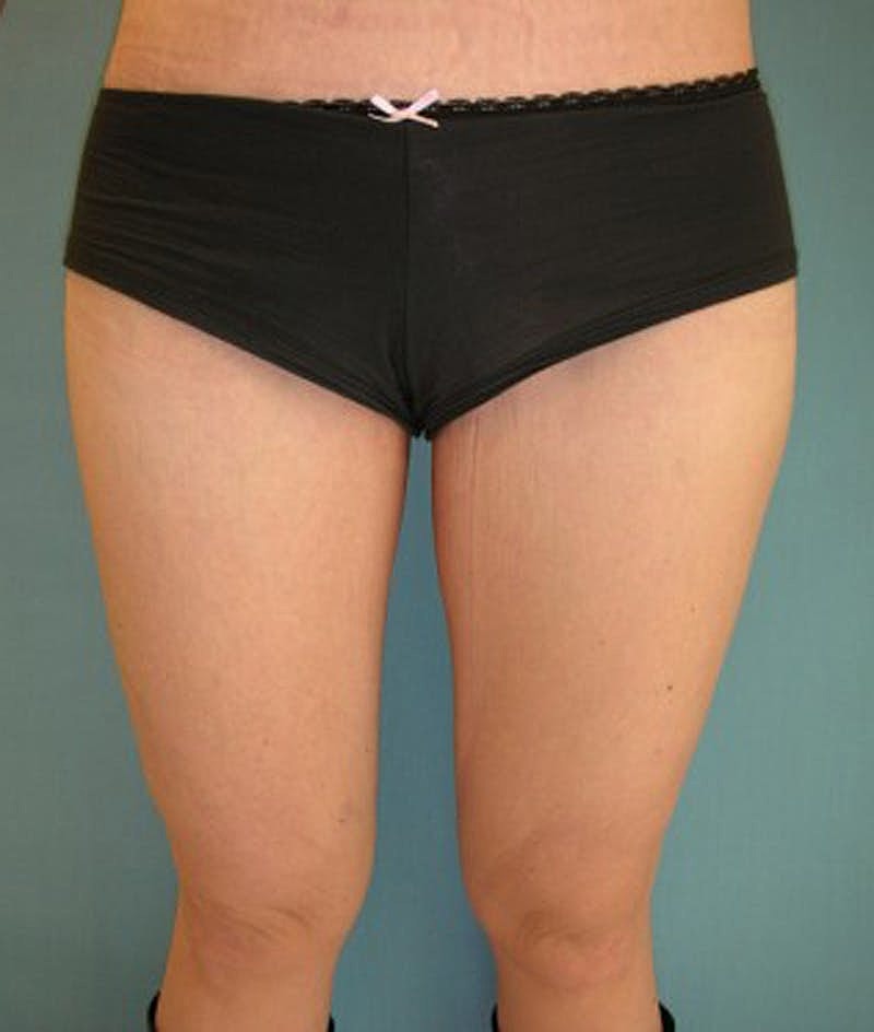 Thigh Lift Before & After