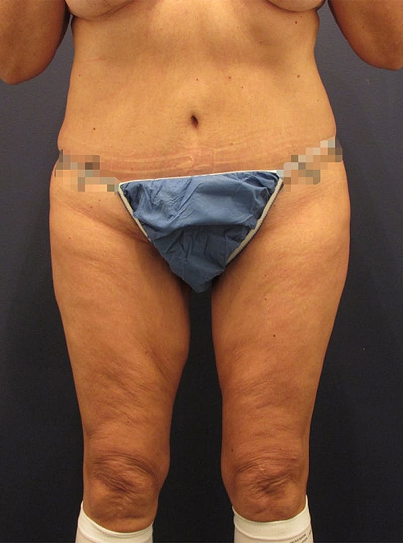 Thigh Lift Before & After
