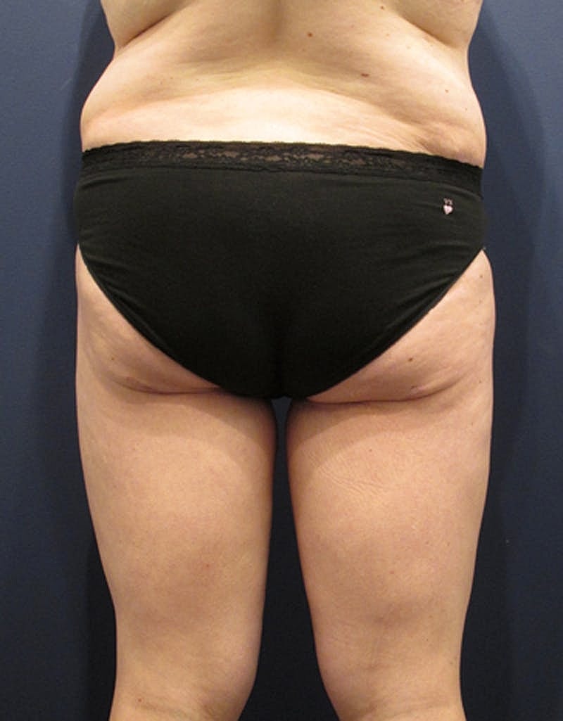 Thigh Lift Before & After
