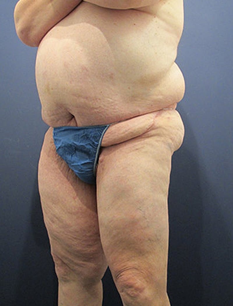 Thigh Lift Before & After