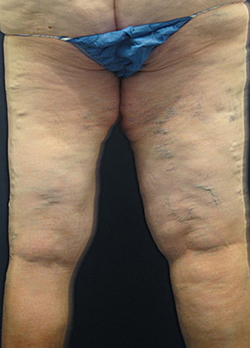 Thigh Lift Before & After