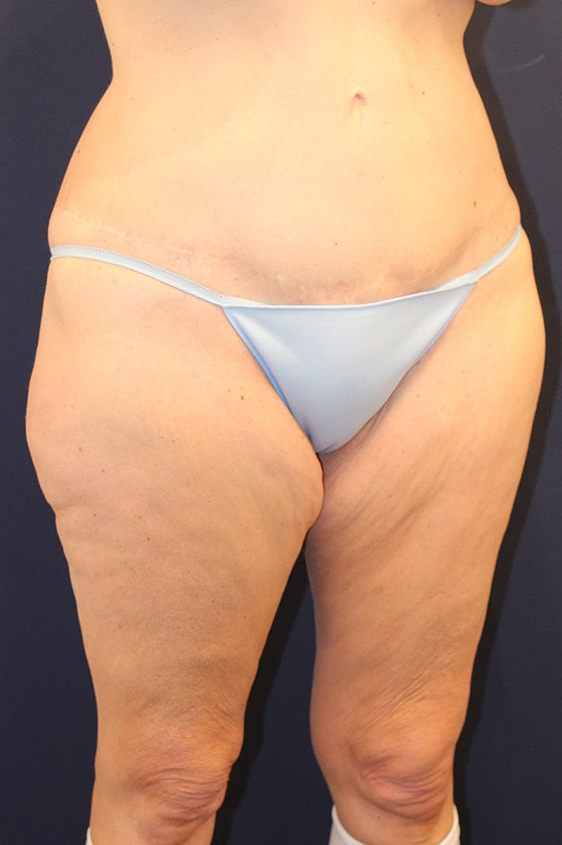 Thigh Lift Before & After