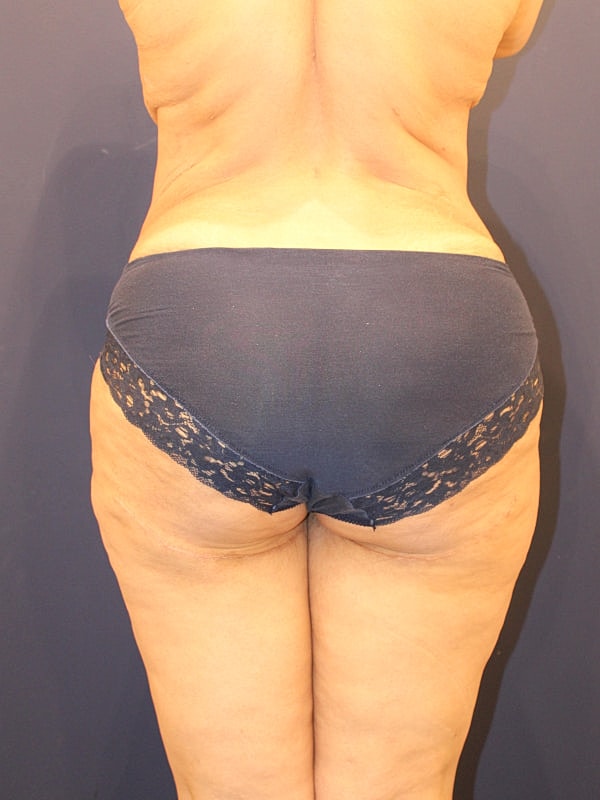 Thigh Lift Gallery Before & After