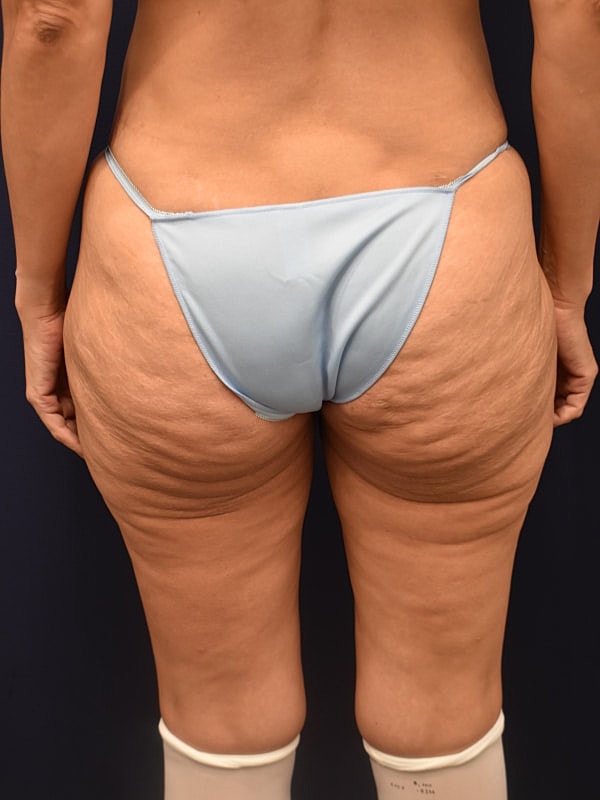 Thigh Lift Gallery Before & After