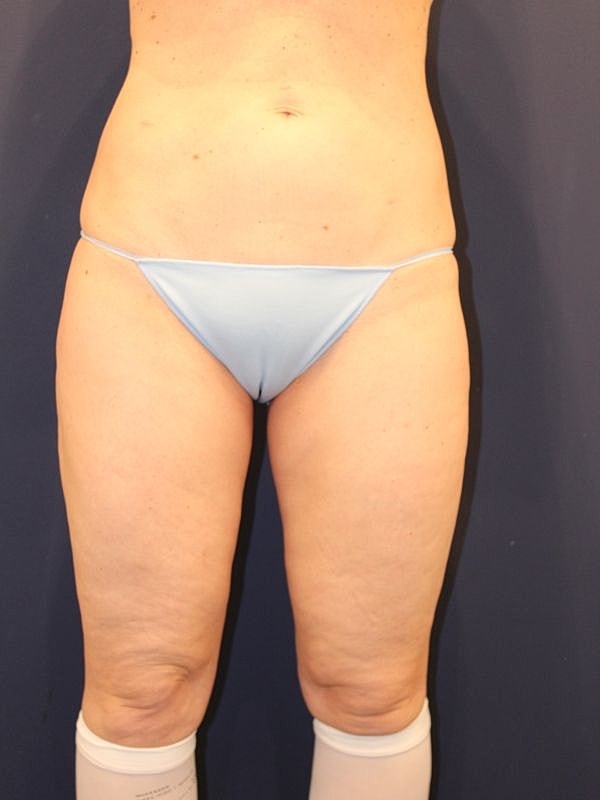 Thigh Lift Gallery Before & After