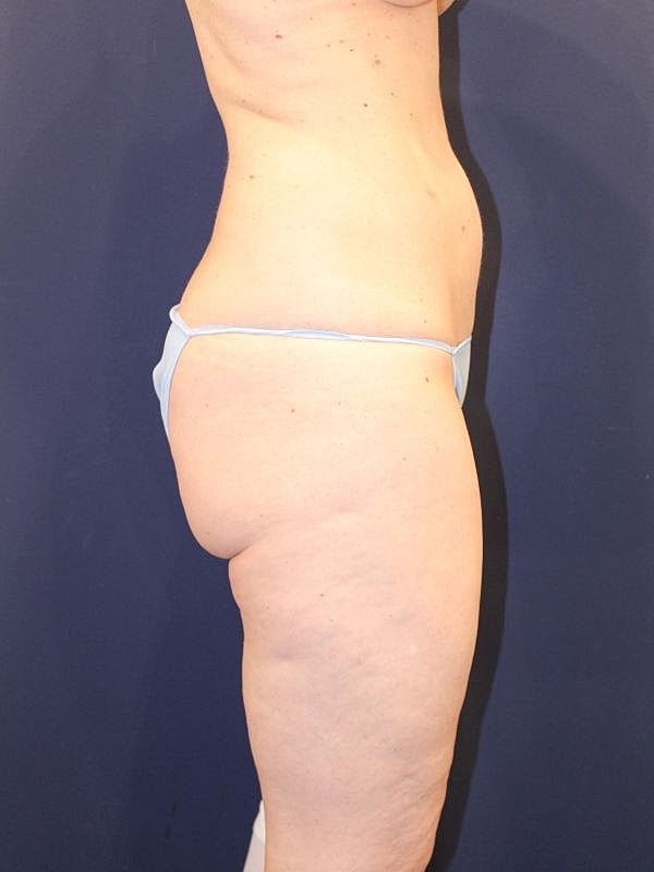 Thigh Lift Gallery Before & After
