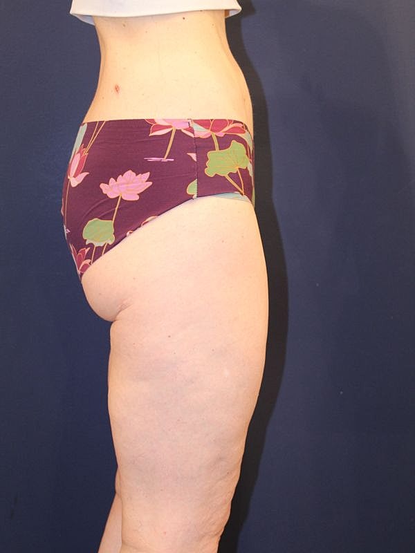 Thigh Lift Gallery Before & After