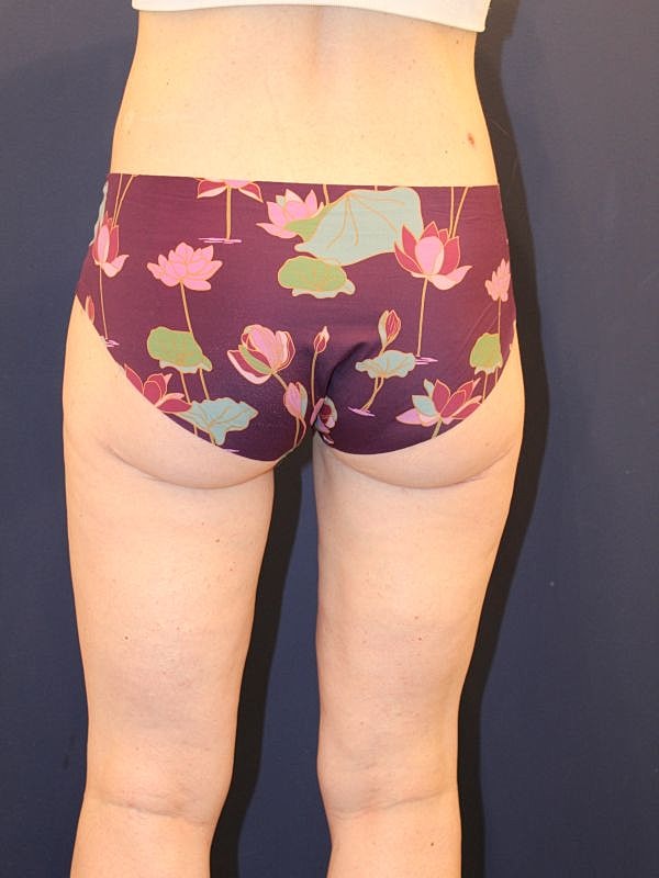 Thigh Lift Gallery Before & After