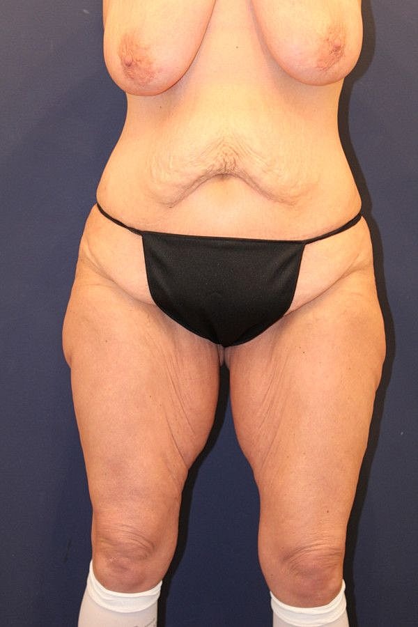 Thigh Lift Gallery Before & After