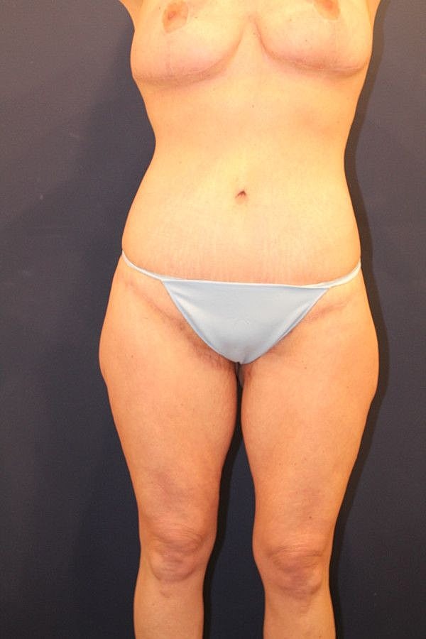 Thigh Lift Gallery Before & After