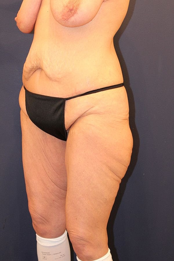 Thigh Lift Gallery Before & After