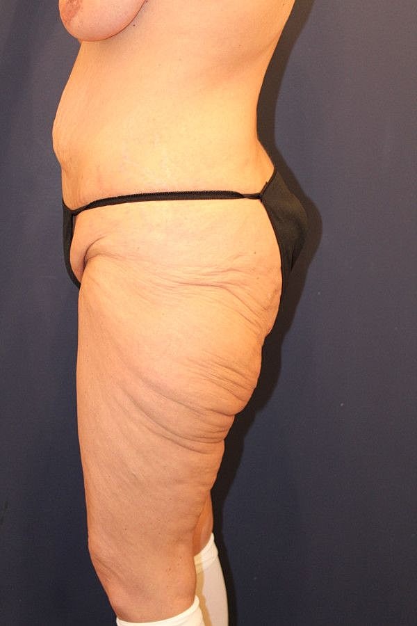 Thigh Lift Gallery Before & After