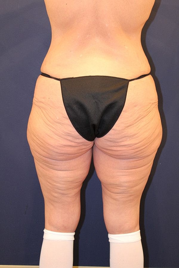 Thigh Lift Gallery Before & After
