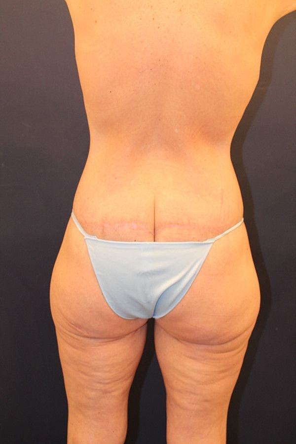 Thigh Lift Gallery Before & After