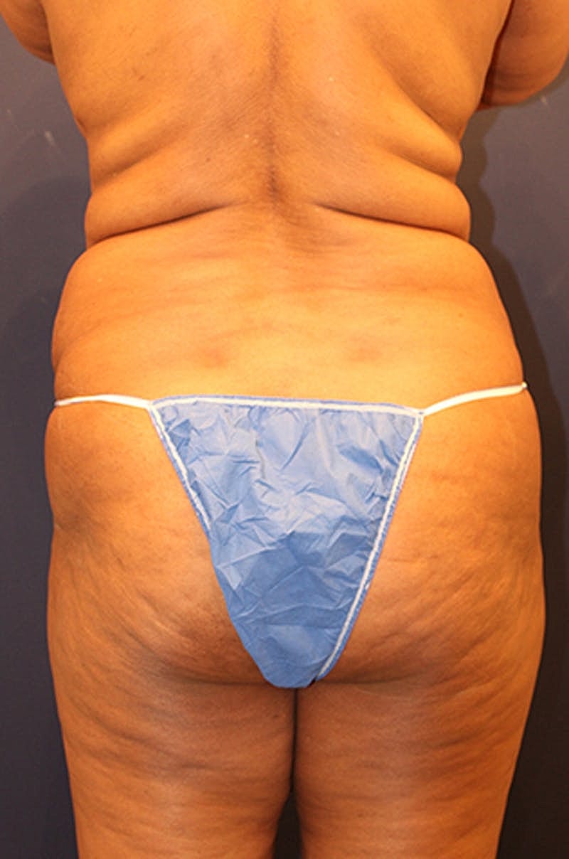 Buttock Fat Transfer Before & After