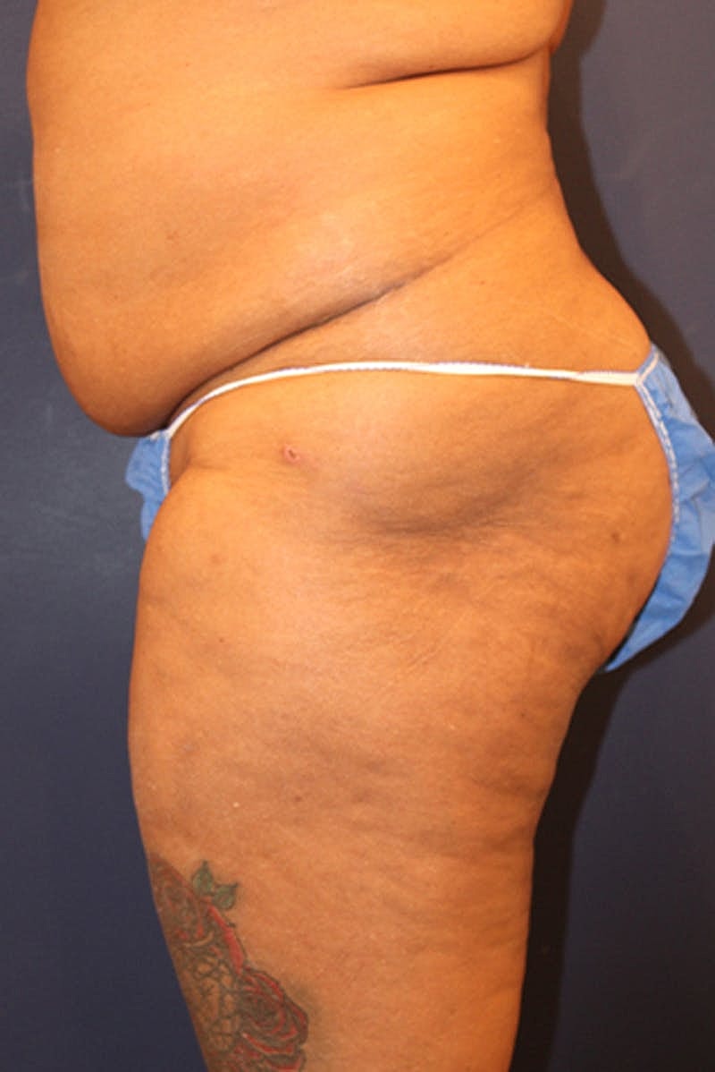 Buttock Fat Transfer Before & After